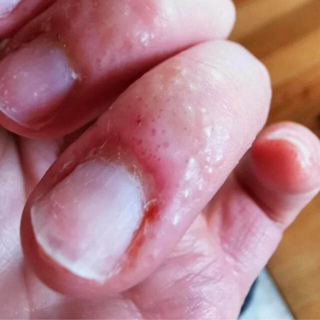 Finger affected by nail allergy showing inflammation