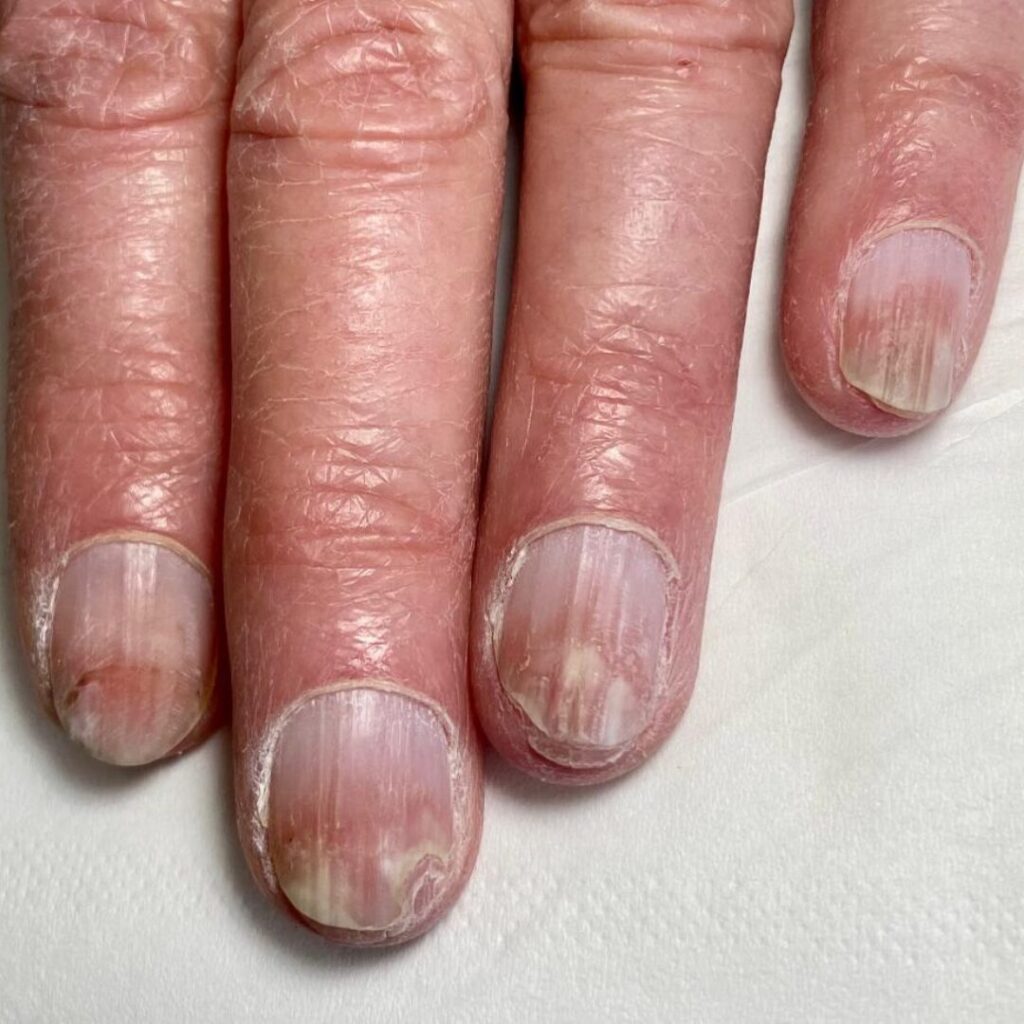 nail allergy image showing 4 fingers affected by allergic reaction to nail products