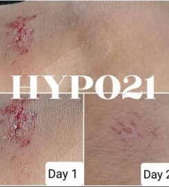 HYPO21 Skin Purifying Products